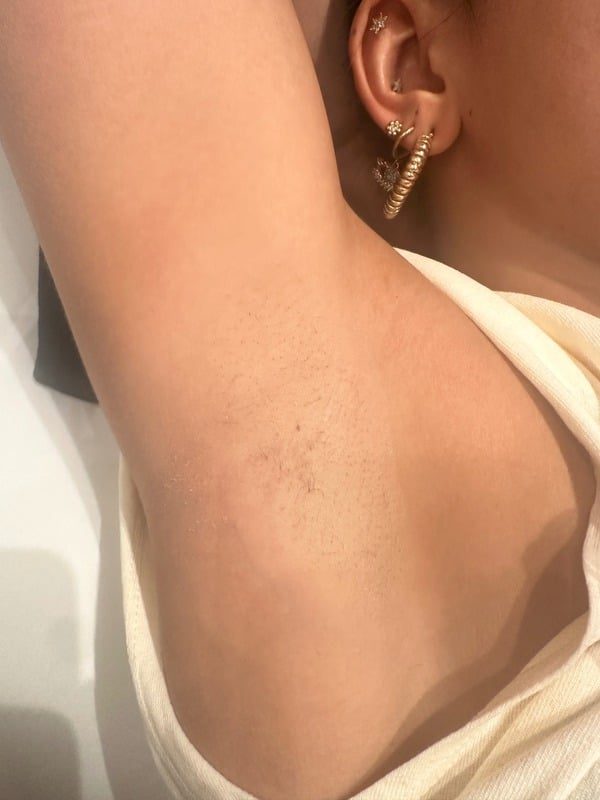 After laser hair removal at Eden Aesthetics: smooth, hair-free underarm skin