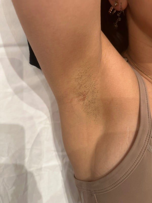 Before laser hair removal: client underarm with visible dark hair